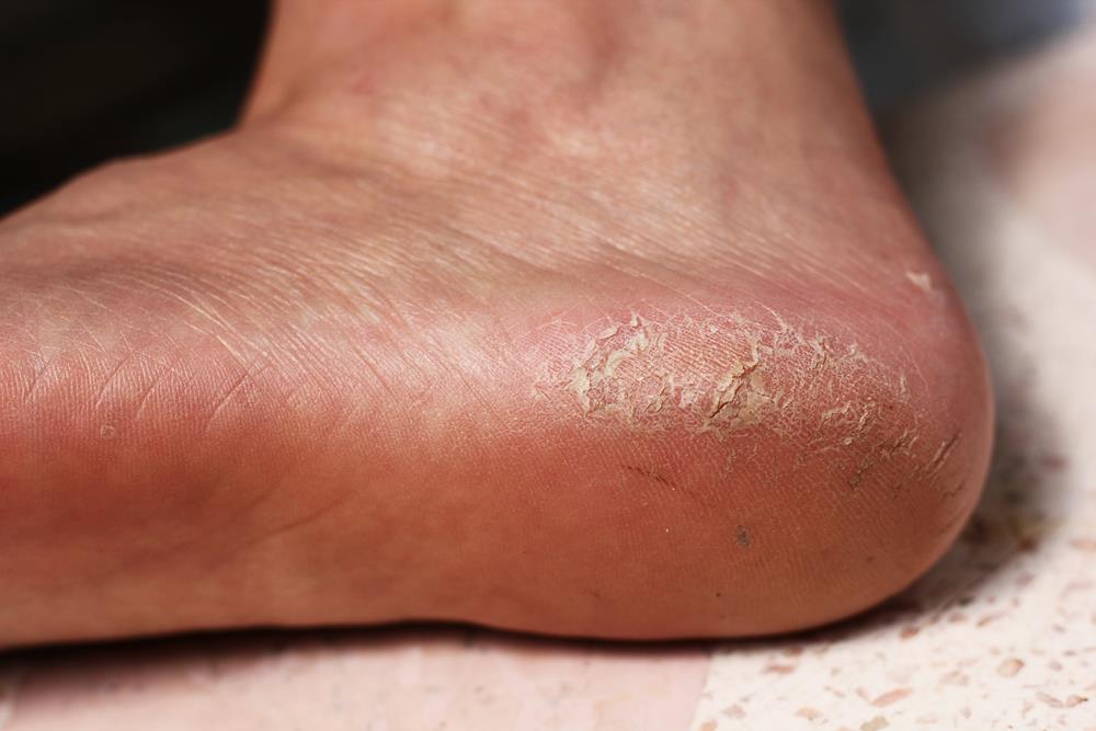 Calluses 